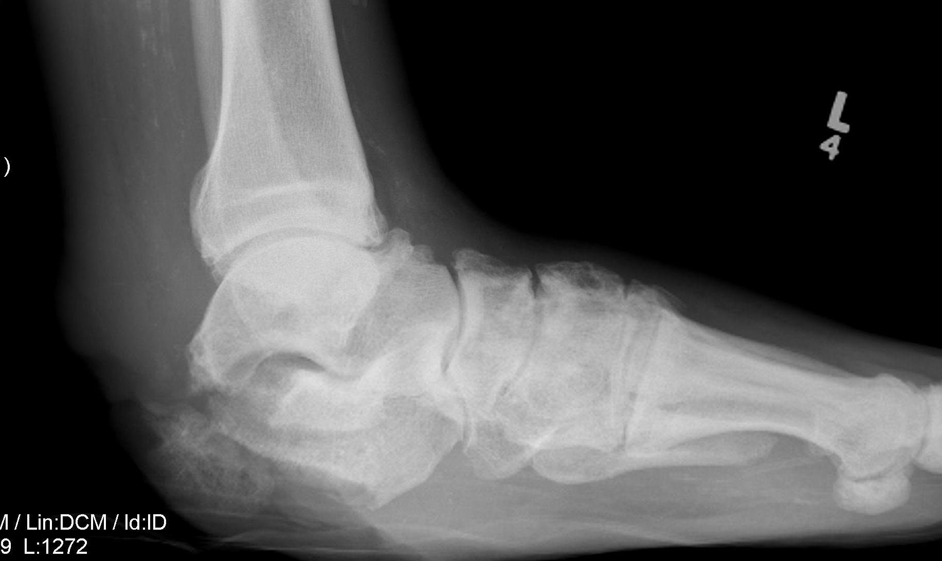 Diabetic Heel Abscess Xray